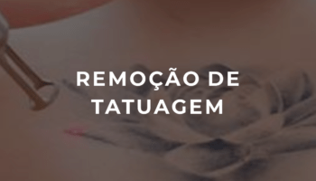 REMOVER TATUAGENS